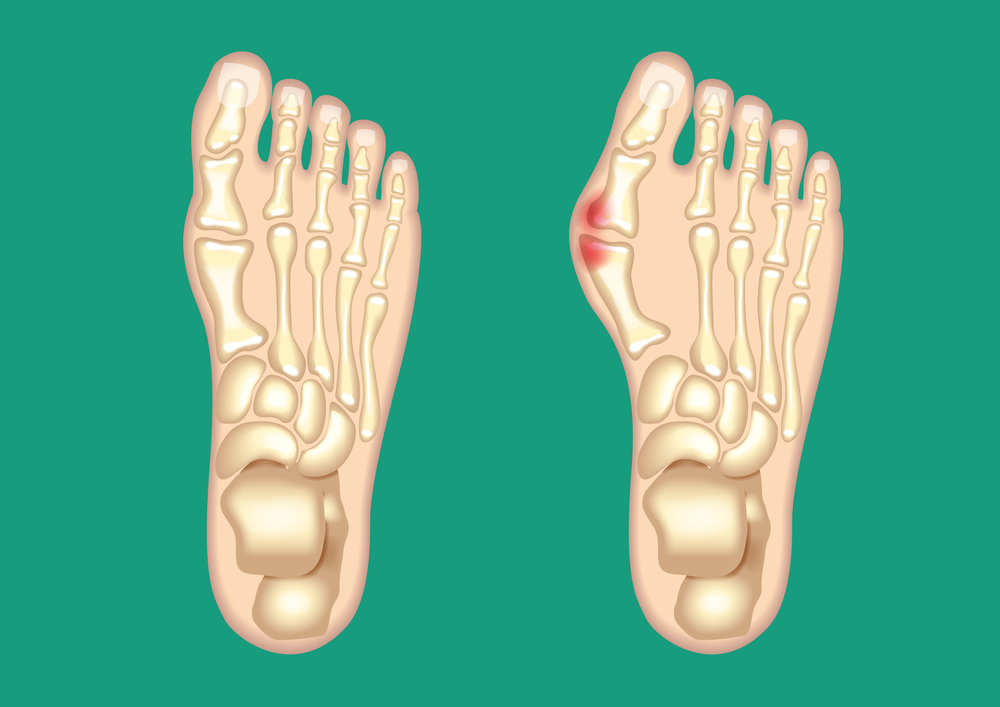 4 Signs You Have Bunions From Rochesters Foot Specialist Podiatry