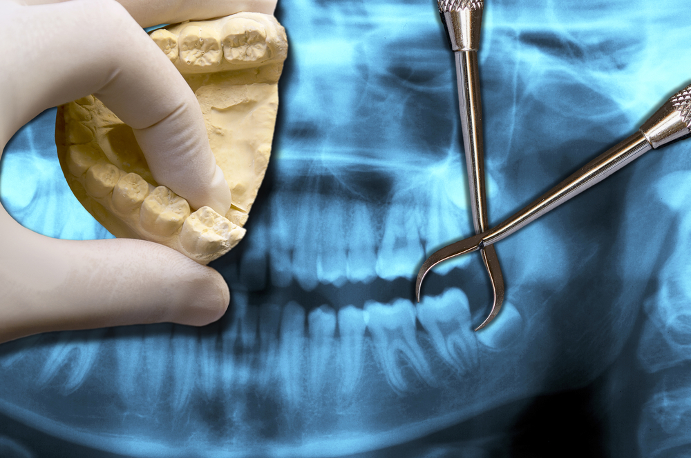 3 Expert Tips for Preparing for a Tooth Extraction