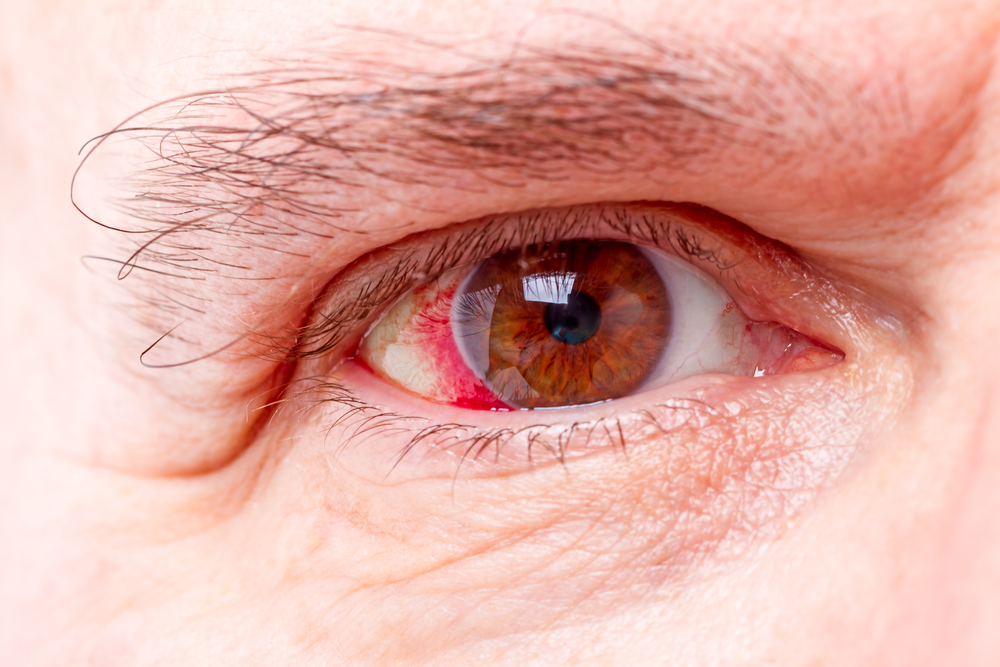 eye-care-experts-discuss-broken-blood-vessels-family-vision-center