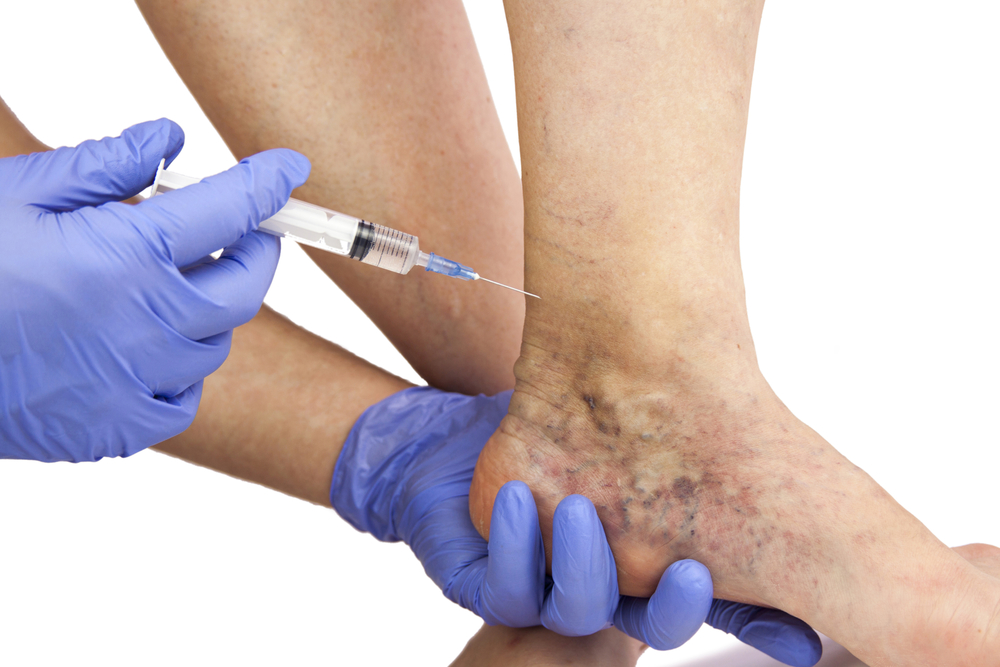 connecticut-dermatologists-explain-what-causes-spider-veins-how-to