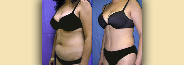 lipo without tummy tuck loose skin