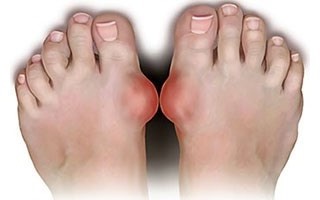 What Is Gout In Foot Symptoms